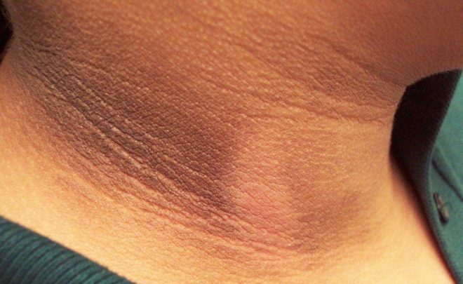 No te falta higiene, las manchas oscuras en la piel pueden revelar problemas de salud
