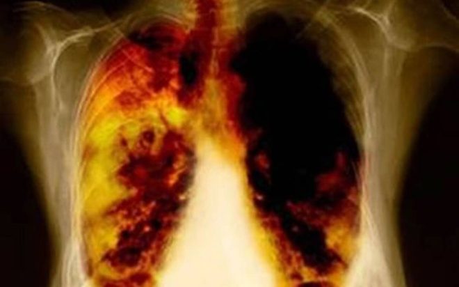 Tres señales de un posible cáncer de pulmón