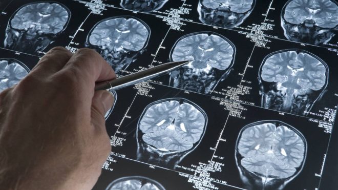 El aterrador positivo a Alzheimer: ¿qué hacer ante tal diagnóstico?